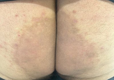 Figure 3. Resolving eruption post treatment.