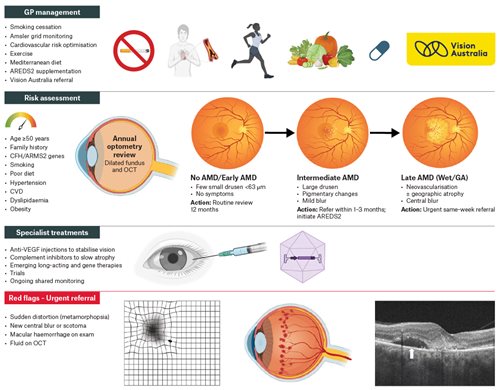 Figure 2. GP referral and management pathway for AMD.