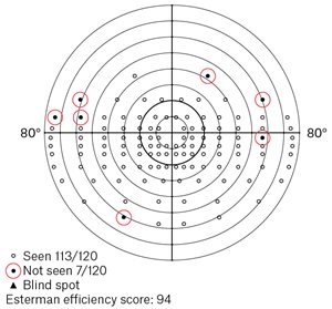 Figure 1. Binocular Esterman with no significant central defect, showing a pass.