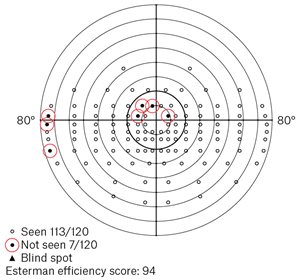 Figure 2. Binocular Esterman with significant central defect, showing a fail.