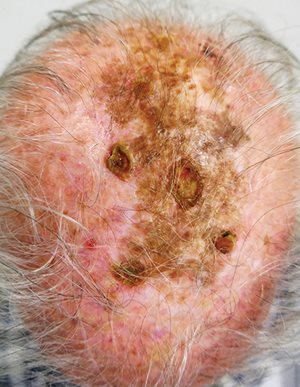 Figure 1. Extensive lentigo maligna of the scalp, with irregular pigmentation and actinic damage. Multiple mapping biopsies showed only lentigo maligna and solar keratosis.