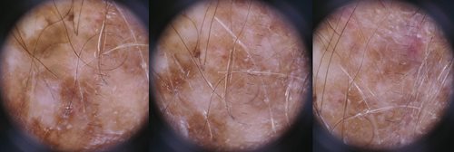 Figure 2. Dermoscopy findings of irregular pigmentation and areas of regression within a background of actinic damage.