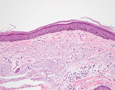 Figure 3. H&E section demonstrating atypical melanocytic proliferation along the dermoepidermal junction, consistent with lentigo maligna. There is one zone of cellular fibrosis and patchy lymphocytic inflammation, which extends through the dermis and into the subcutis. In this region there are plump spindle cells set between sclerotic collagen bundles.