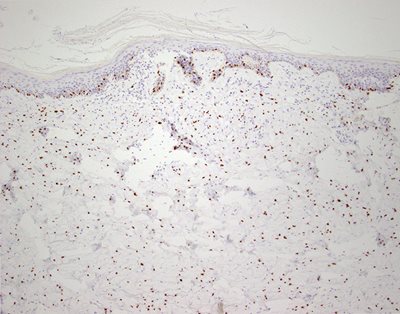 Figure 4. SOX10 immunostaining highlighting intradermal spindle cells, confirming the diagnosis of desmoplastic melanoma.