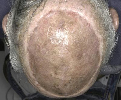 Figure 5.  Healed scalp following wide local excision and split-thickness skin graft reconstruction. The patient experienced no local recurrence and remains disease-free at 5-year follow-up.