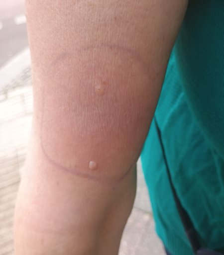 Figure 1. Erythematous rash on the right upper lateral arm of a woman aged 73 years – the two papules are pre-existing skin lesions, though their appearance was more evident than usual with the rash.