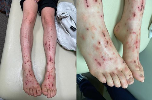 Figure 1. Bilateral lower limb pruritic eruption with bullae and excoriations.