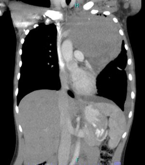 Figure 2. Coronal view of chest CT scan showing a mediastinal mass and left-sided pleural effusion. CT, computed tomography.