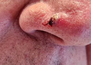 Figure 1. Basal cell carcinoma of the right nasal ala.