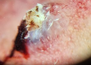 Figure 2. Dermoscopy showing basal cell carcinoma features.