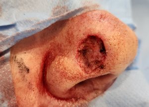 Figure 3. Wound-bed immediately post excision.