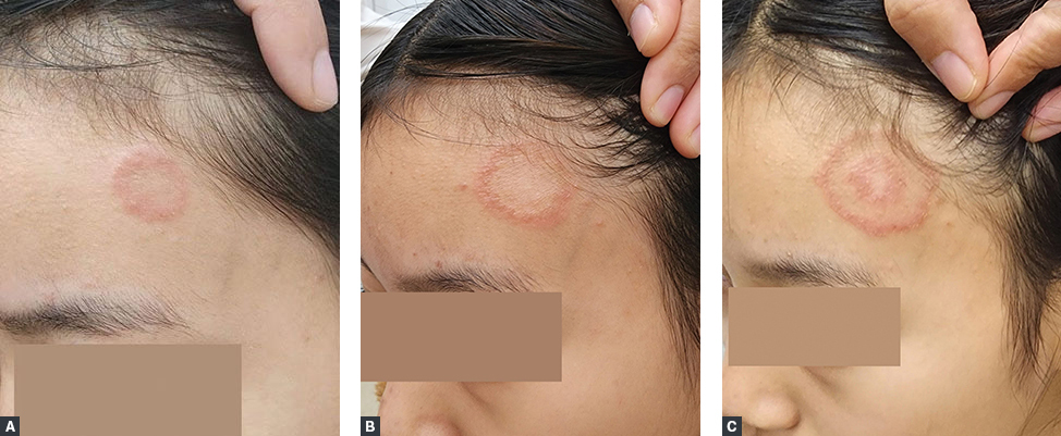 Figure 1A. Annular erythema at 1 week from onset; B. Expanding annular erythema at 2 weeks from onset; C. Development of a new ring within an existing ring at 3 weeks from onset.
