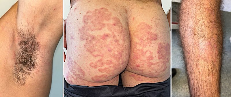 Figure 3A. Resolved axilla rash; B. Fading of erythematous rash on buttocks; C. Improved erythema and resolving pustules on right shin.