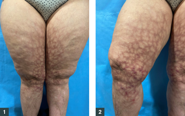 Figures 1 and 2. Reticulated erythematous and hyperpigmented patches on both inner thighs and legs