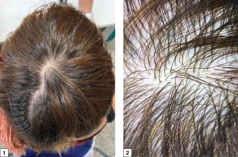 Figure 1. Diffuse loss of hair volume without any defined alopecic patches. Figure 2. Numerous follicular units of only one hair and without anisotrichosis (hair shafts with different diameters); no trichoscopic signs of alopecia areata or other kinds of alopecia