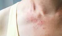One in three Australian children are diagnosed with eczema.
