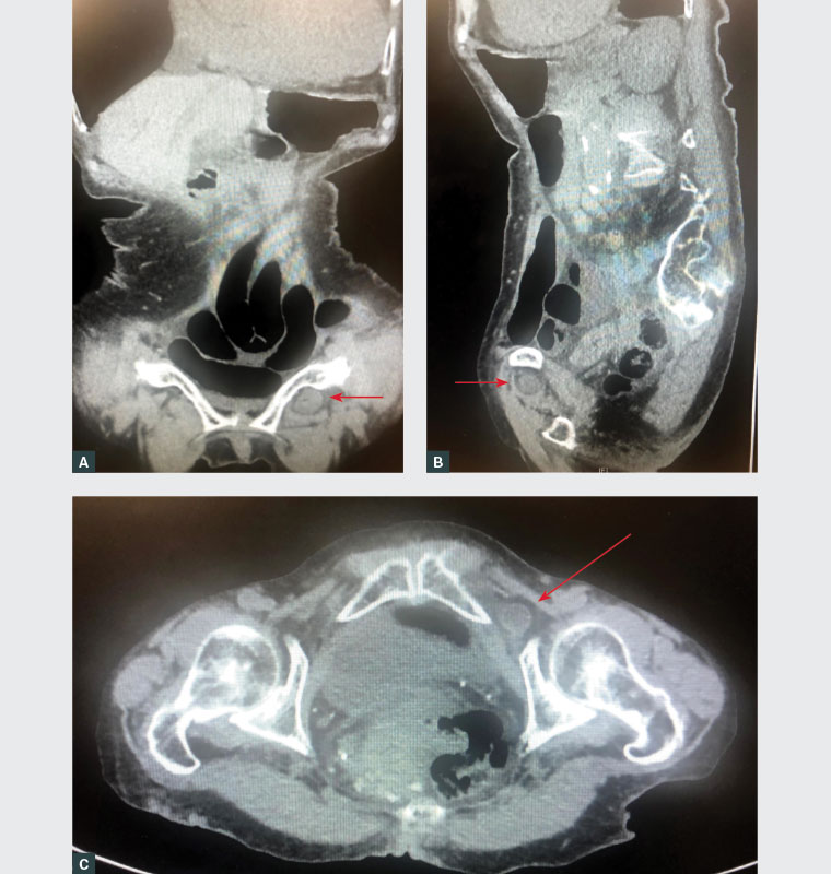 Figure 1. Computed tomography scans demonstrating small bowel obstruction secondary to a left sided incarcerated obturator hernia (arrows).  A. Coronal view; B. Sagittal view; C. Axial view