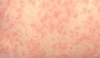 GPs were forced to maintain a high level of suspicion for measles with every at-risk patient who presented with a rash. (Image: CDC/Dr Heinz F Eichenwald)