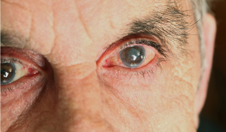 Older man with damaged eyes