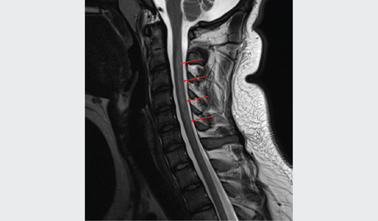 Figure 2. Sagittal cervical spine magnetic resonance imaging at presentation, showing T2-weighted signal abnormality from C1 to C7 levels in the dorsal columns (red arrows), typical of subacute combined degeneration of the spinal cord
