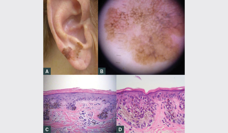Figure 1. Lesion at presentation. A. Macroscopic appearance; B. Dermoscopy; C. Histopathology demonstrating unstable solar lentigo; D. Histopathology demonstrating lentigo maligna