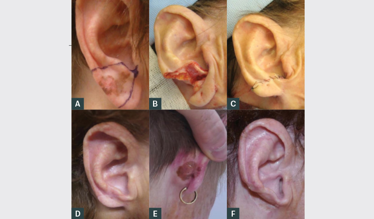 Figure 2. Lentigo maligna management and progression. A. Preoperative excision marked; B. Excision of lesion; C. Closure of wedge excision; D. Six weeks post-operation; E. Recurrence 4.5 years post–initial wedge excision; F. Result of recurrence excision
