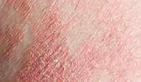 GPs have been urged to take advantage of new PBS listing for psoriasis.