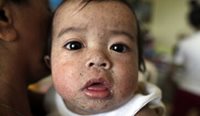 Infant with measles