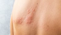 Person with shingles