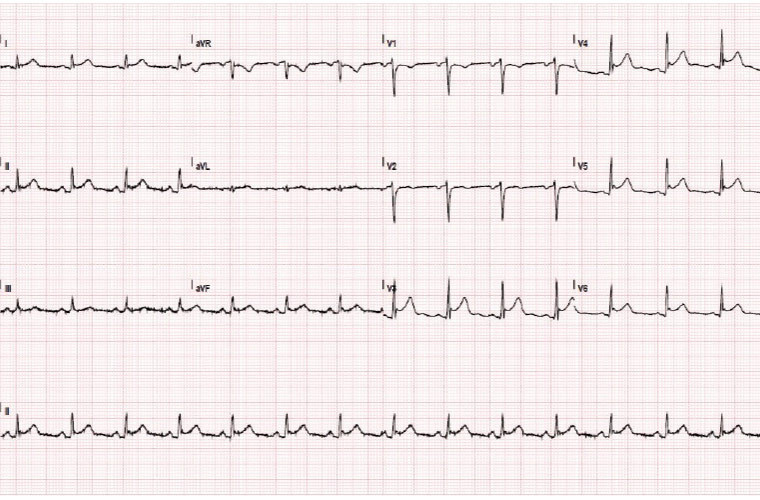 Figure 1. Electrocardiogram taken during chest pain