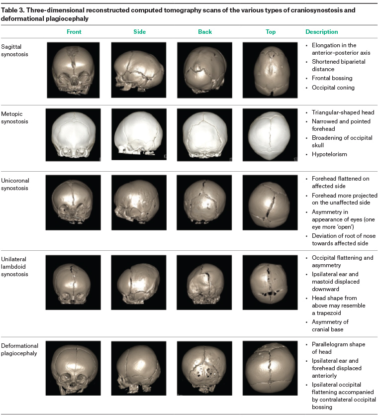 Table 3. Three-dimensional reconstructed computed tomography scans of the various types of craniosynostosis and deformational plagiocephaly