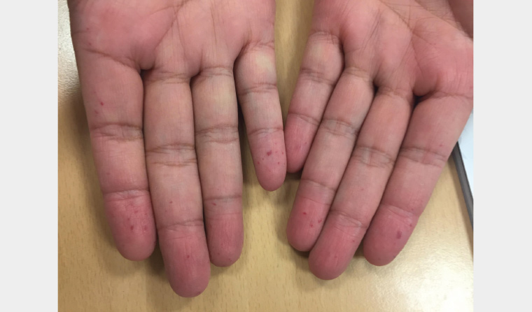 Figure 1. Multiple pinhead-sized flat red spots on the patient’s hands