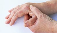Hand with arthritis