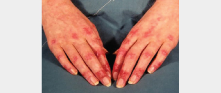 Figure 4. Dermatomyositis of the hands showing Gottron’s papules