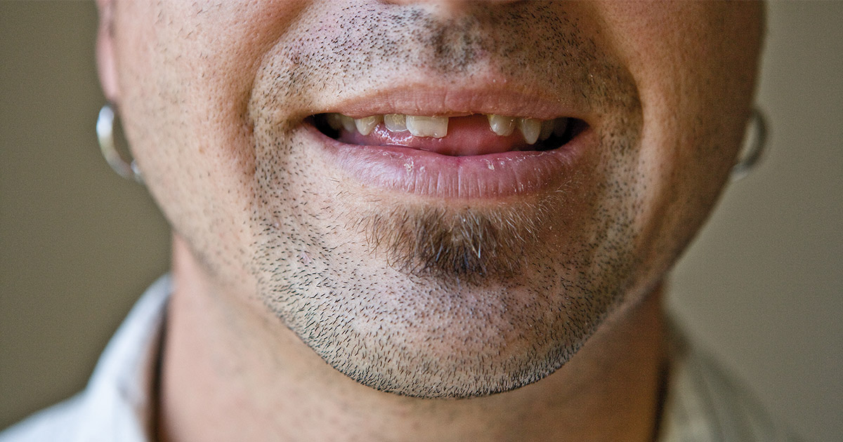 Why is one side of my face more swollen than the other after my  orthognathic surgery? - Instituto Maxilofacial