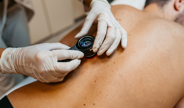 Doctor conducting skin cancer check on man's back.