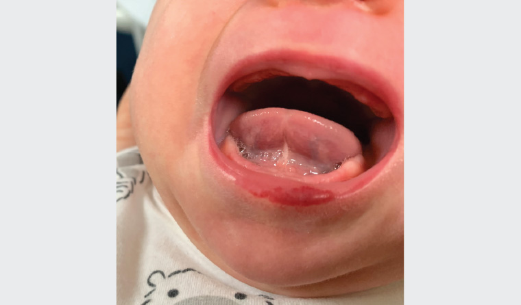 Figure 3. Infantile haemangioma affecting the lower lip