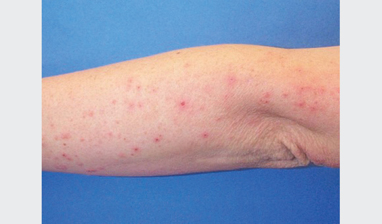Figure 4. Prurigo of pregnancy: excoriated papules on the extensor surface of the arm