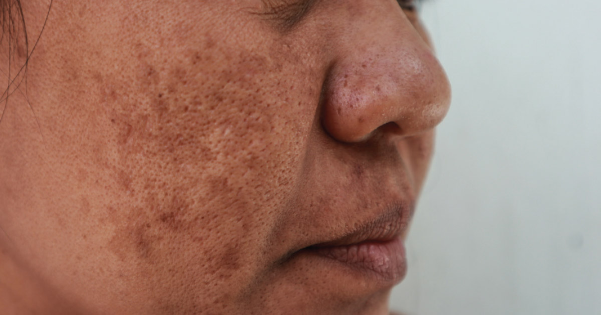 Skin Discoloration from Amiodarone
