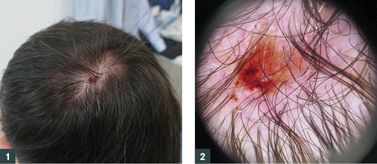 Figure 1. Ulcerated papule scalp lesion. Figure 2. Dermoscopy of the lesion