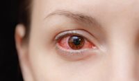 Management of microbial keratitis in general practice