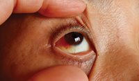 Ophthalmic trauma: First-line management in primary care