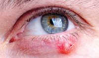 Eyelid lesions in general practice