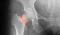 Menopause and osteoporosis: Epidemiology, pathophysiology, screening and diagnosis