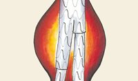Abdominal aortic aneurysm: An update