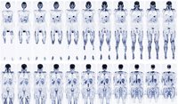 Overdiagnosis and overtesting