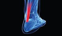 The Achilles tendon: Management of acute and chronic conditions