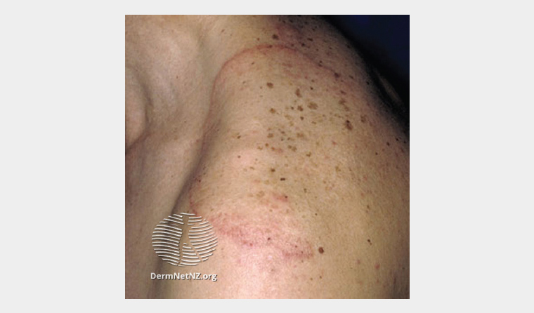 Figure 1. Tinea corporis: erythematous leading edge with central clearing.