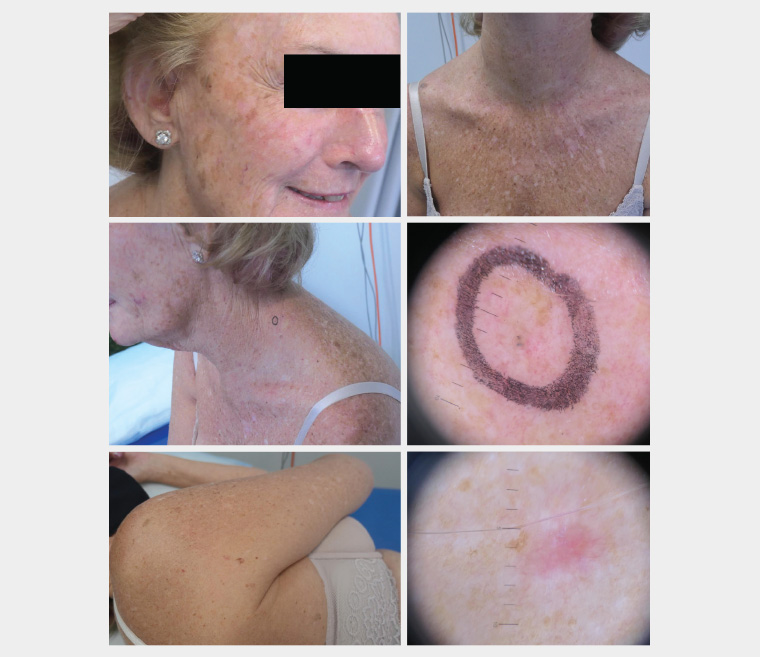 Photomontage of a woman with significant solar damage with numerous solar keratoses and two small basal cell carcinomas